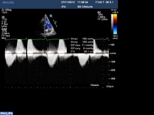 doppler pulm antero