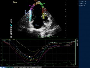 strain longitudinal VD