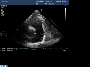 voie pulmonaire Grand Axe